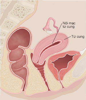 Mặt cắt ngang khung chậu của người phụ nữ cho thấy tử cung và niêm mạc tử cung.
