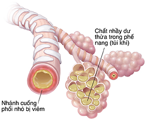 Nhánh cuống phổi nhỏ và các túi phế nang tích tụ dịch nhầy và viêm do viêm phổi.