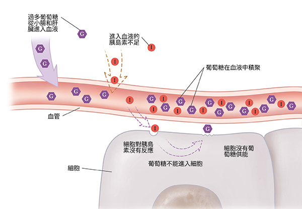 2 型糖尿病細胞附近血管的特寫截面圖。細胞對胰島素沒有反應。葡萄糖不能進入細胞並在血液中積聚。