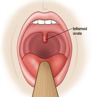 Open mouth with tongue being held down by tongue depressor, showing inflamed uvula.