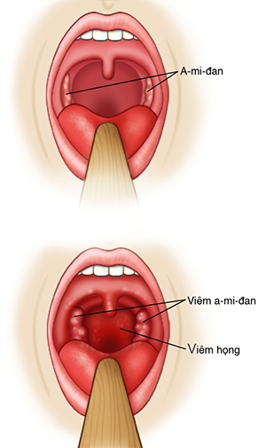 Hai hình chụp gần của cổ họng cho thấy các a mi đan bình thường và các a mi đan cổ họng bị sưng.