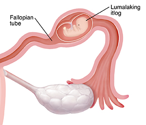 Malapitang kuha ng cross section ng fallopian tube na may embryo na lumalaki sa loob sa ectopic pregnancy.