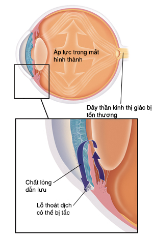 Mặt cắt của mắt cho thấy áp lực tăng lên. Hình in cho thấy các lỗ thoát nước bị tắc.
