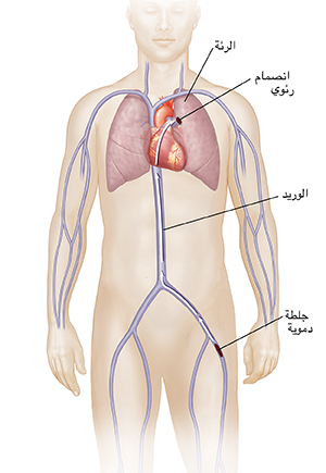 صورة أمامية لشكل توضيحي لذكر بالأسهم تُظهر مسار الجلطة الدموية من وريد الساق إلى الرئة، مسببة انصمامًا رئويًا.