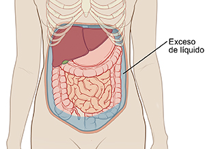 Contorno del abdomen de una mujer donde pueden verse los órganos abdominales. Hay líquido que está llenando el abdomen alrededor de los órganos.