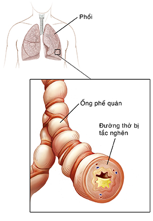 Phác họa ngực người cho thấy khí quản và phổi. Cận cảnh ống phế quản cho thấy viêm và tích tụ chất nhầy.