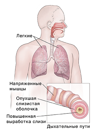 Вид человека спереди: показаны органов дыхания. На меньшем изображении показаны воспаленные дыхательные пути.