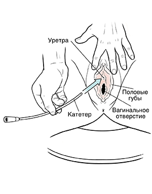 Крупный план вульвы, показывающий руки, которые вводят катетер в уретру.