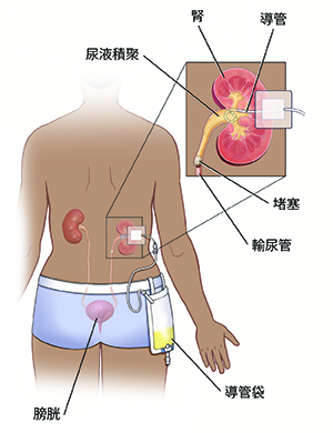 患者的後視圖,顯示了他們的尿路,以及腎造口管和導管袋。插圖顯示腎臟堵塞和腎造口管閉合。