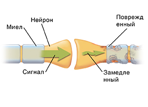 Крупный план синапса в месте, где два нейрона близко прилегают друг к другу. Стрелки показывают, как импульс проходит через здоровый нейрон и разрушается в поврежденном.