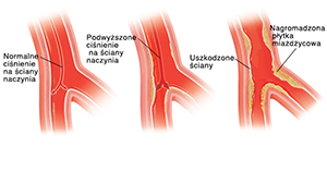 Przekrój tętnicy ze strzałkami pokazującymi normalne ciśnienie krwi na ściany wewnętrzne. Przekrój tętnicy ze strzałkami pokazującymi podwyższone ciśnienie krwi na ściany wewnętrzne. Przekrój tętnicy pokazujący uszkodzoną błonę z płytką miażdżycową.