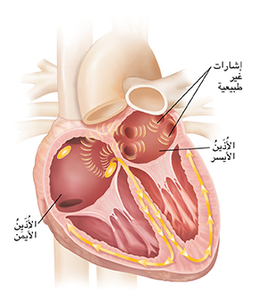 مقطع عرضي للقلب يُظهر الرجفان الأذيني.